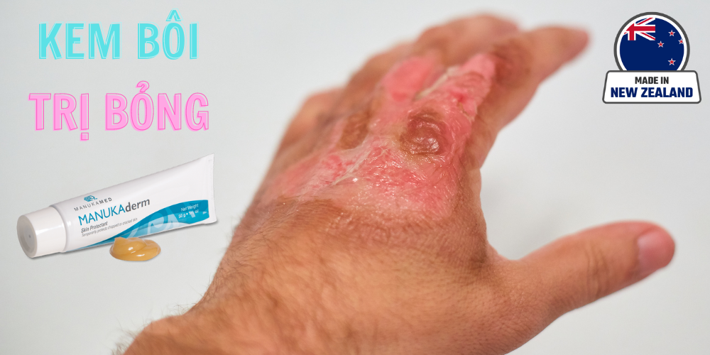Kem bôi Manukaderm giúp chữa lành và ngừa nhiễm trùng do bỏng